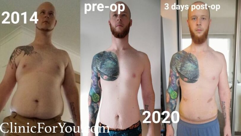 Zabieg liposukcji brzucha
