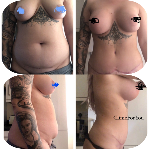 Abdominoplastyka